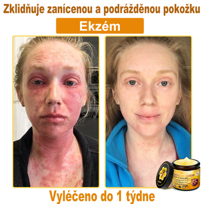 🐝👨‍⚕‍Sinvie® Krém na obnovu pleti s včelím jedem(👨‍⚕‍CE schváleno)👍✅