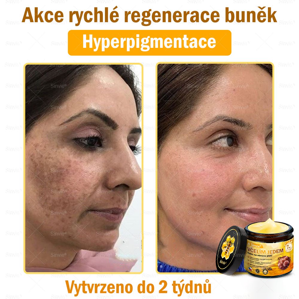 🐝👨‍⚕‍Sinvie® Krém na obnovu pleti s včelím jedem(👨‍⚕‍CE schváleno)👍✅