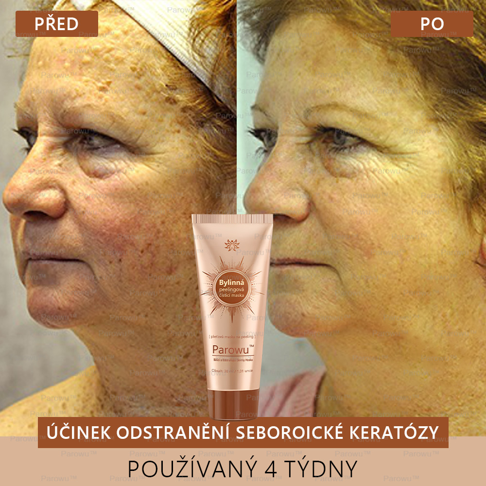 𝗣𝗮𝗿𝗼𝘄𝘂™ Bělící a Odstraňující Skvrny Maska – Přírodní složky trvale odstraňují pigmentové skvrny, stařecké skvrny, pihy a sluneční skvrny.